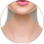 3D skin tech treatment targeting the neck