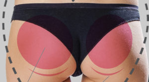 3D celebrity bum lift treatment in Nottingham