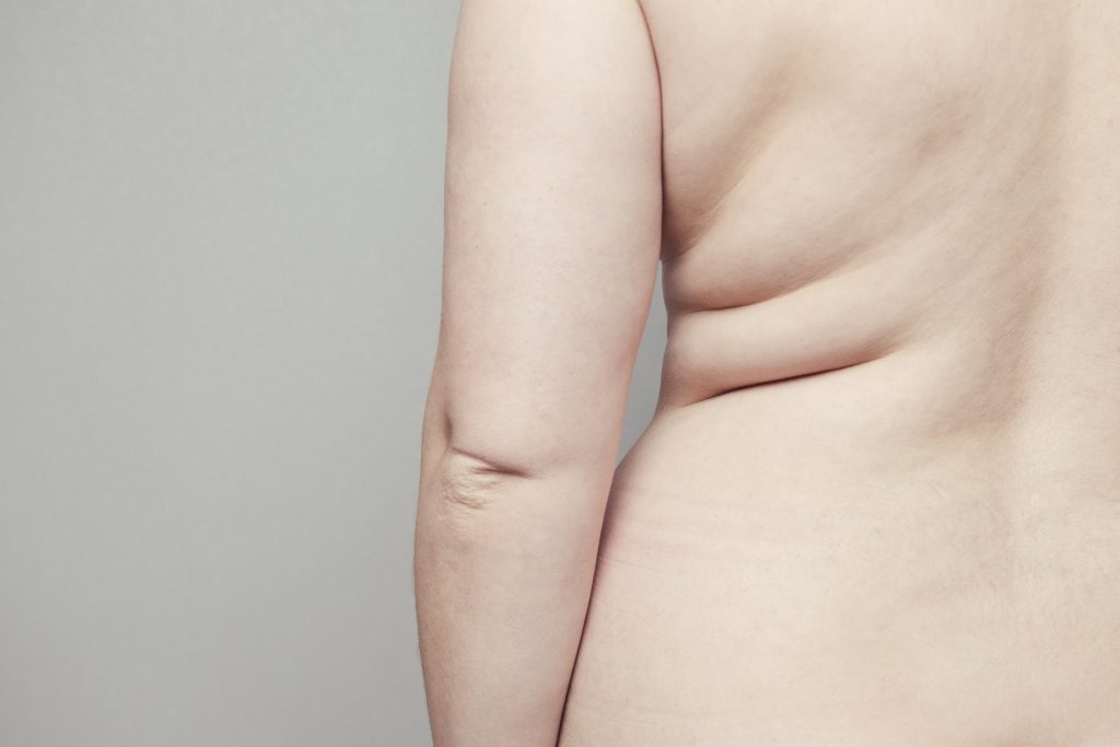 Back of a female naked thick body with folds on the skin. Obesity and End Disease